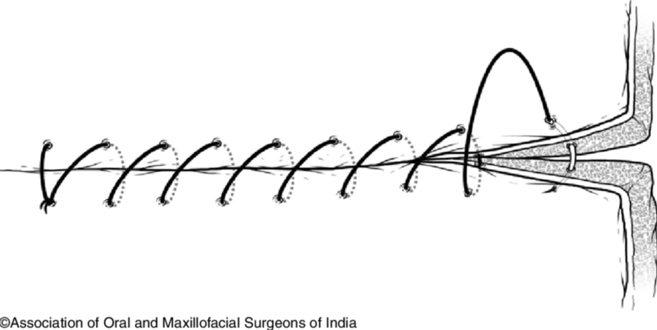 Screenshot 2024-04-08 at 2.32.00 PMhttps://www.researchgate.net/figure/Simple-continuous-suture_fig4_349396765